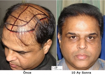 Arap Turistler Saç Ekimi İçin Türkiye’ye Akın Ediyor