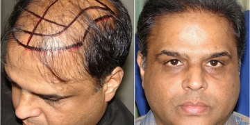 Arap Turistler Saç Ekimi İçin Türkiye’ye Akın Ediyor