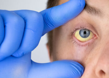 Kadınlarda daha çok görülen anemi sorunun sebebi ve tedavi yöntemleri merak ediliyor. Peki, anemi belirtileri nelerdir?